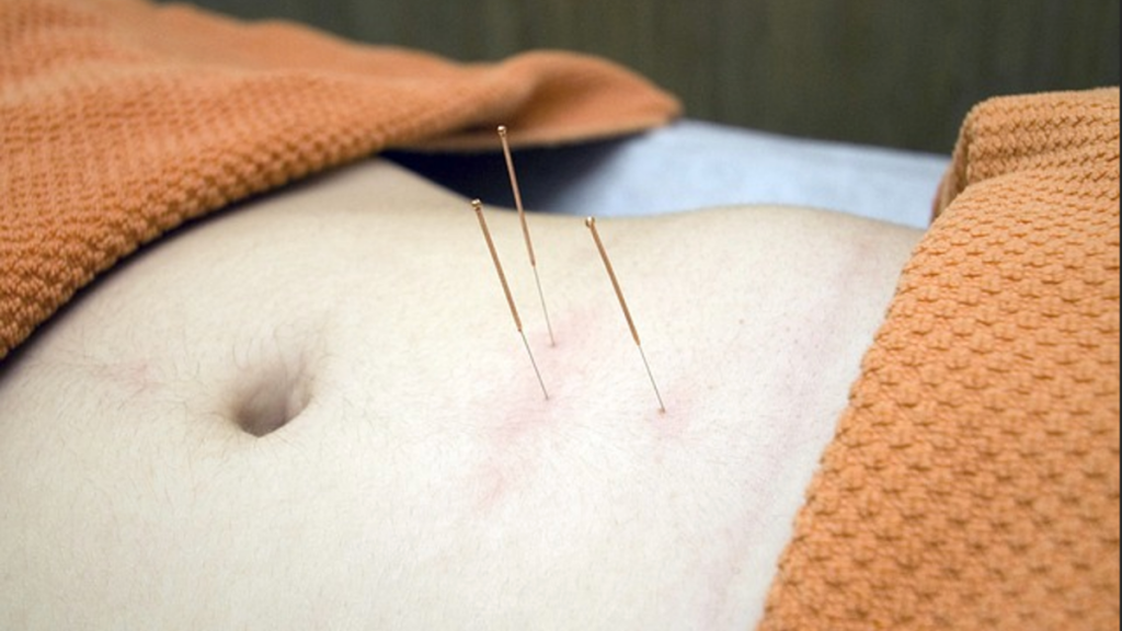 5 Tried and Tested Ways that Acupuncture Decreases Stress